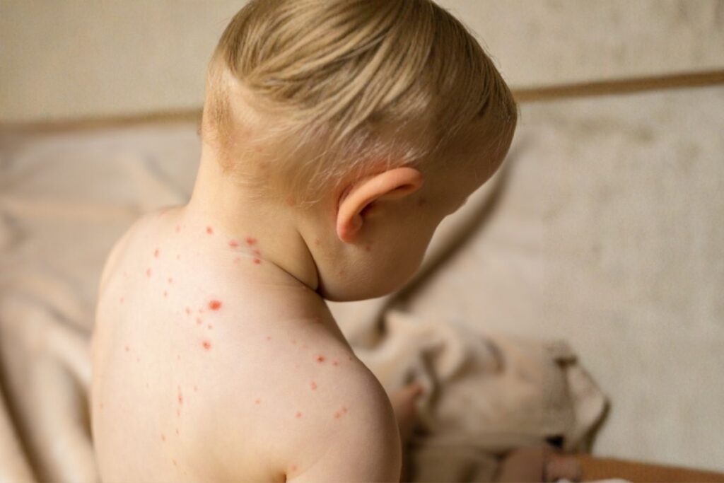 measles outbreak